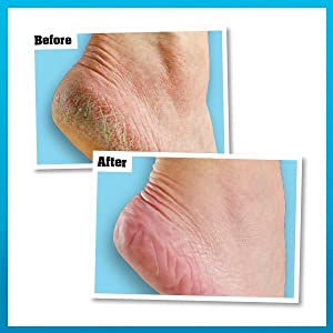 Healthy Feet Results