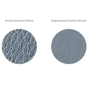 Enamel erosion