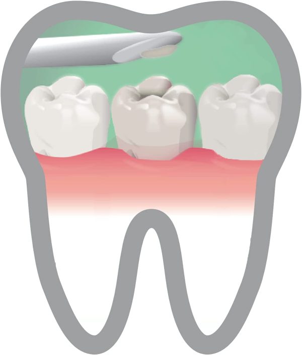 Home Dental First Aid Kit for repairing lost fillings or securing loose caps, crowns or inlays - Image 4