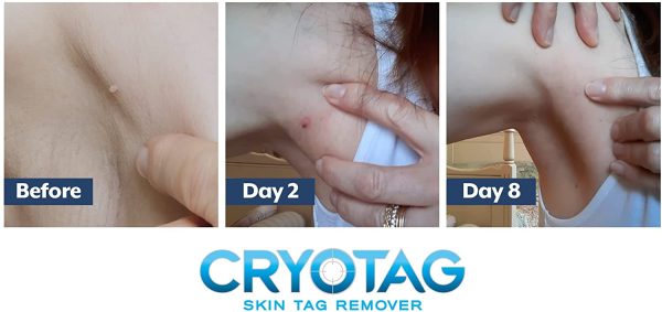 Cryotag Skin Tag Remover - Fast Effective Safe - up to 12 Treatments