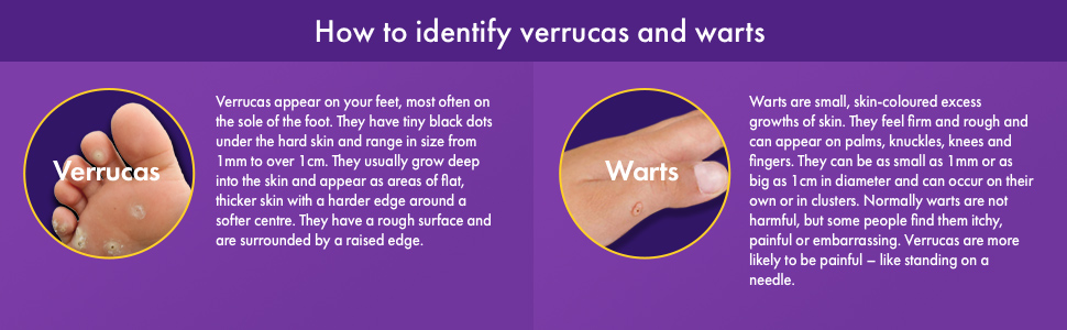 How to identify verrucas and warts