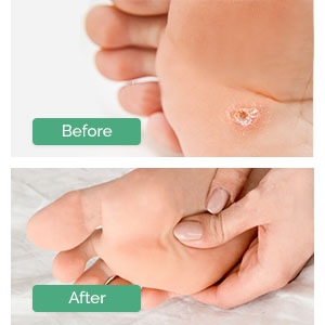 repair hard calluses dead skin